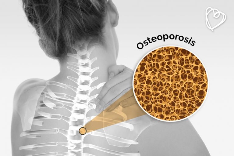 Mujeres Más Propensas A Padecer Osteoporosis Imss 9097