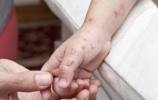 Alertan por presencia de virus Coxsackie en municipios del sur del Edomex