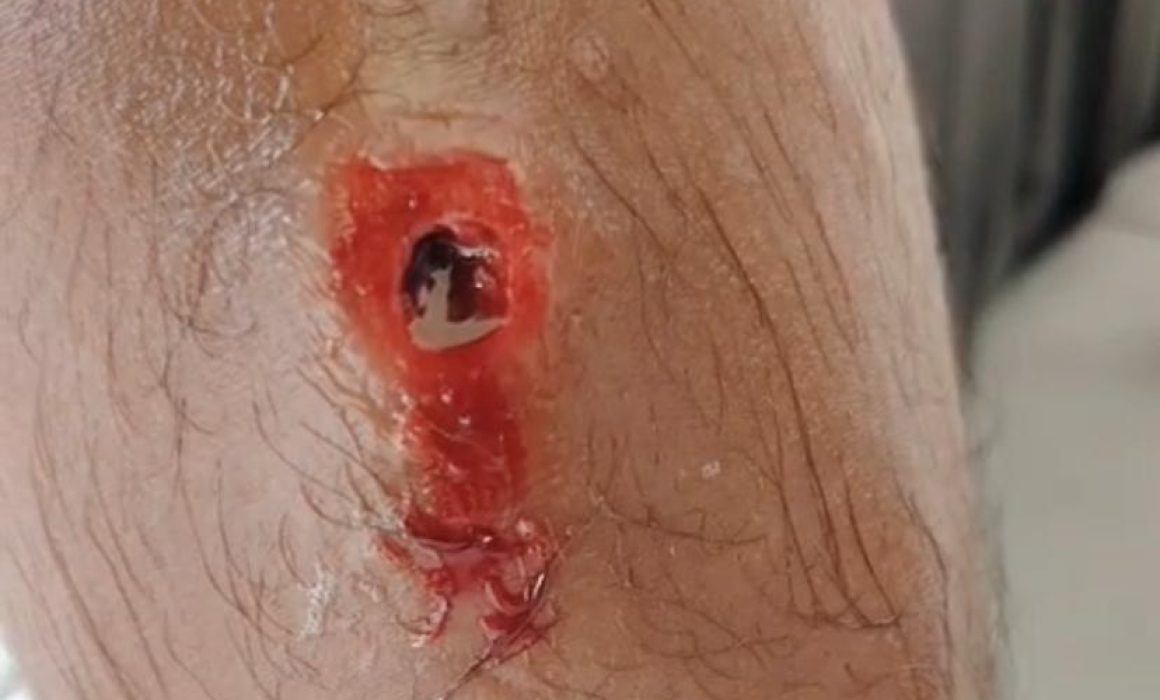 Cubano de la caravana es atendido en el hospital por miasis
