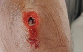 Cubano de la caravana es atendido en el hospital por miasis