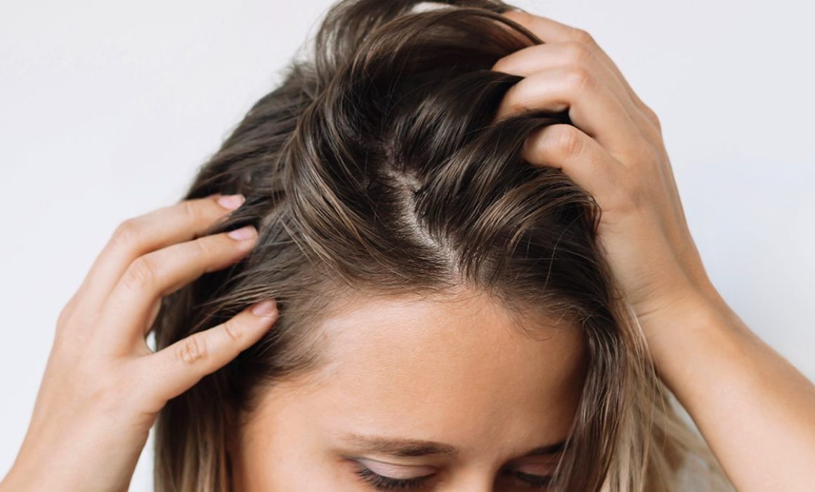 Causa estrés navideño caída de cabello